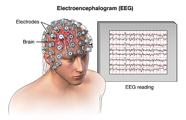 electroencephalogram-eeg.jpg